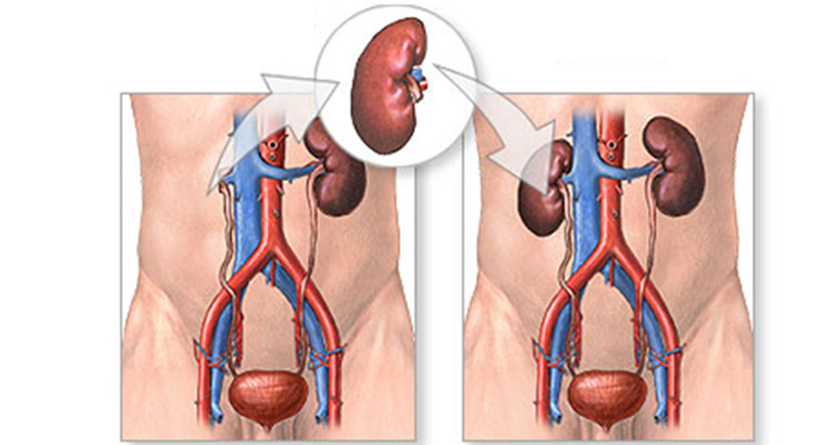 Kidney Transplant Specialist in Noida