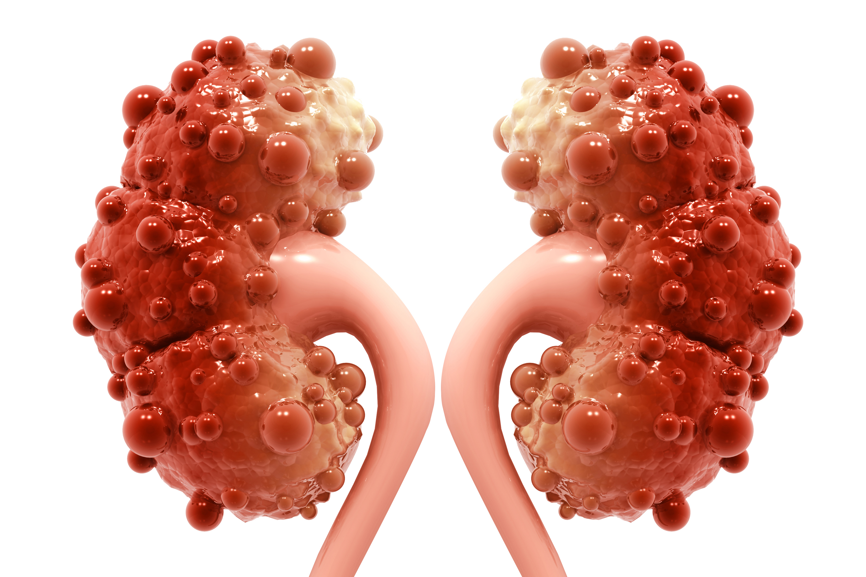 Cystic Disease of Kidney Treatment in Noida