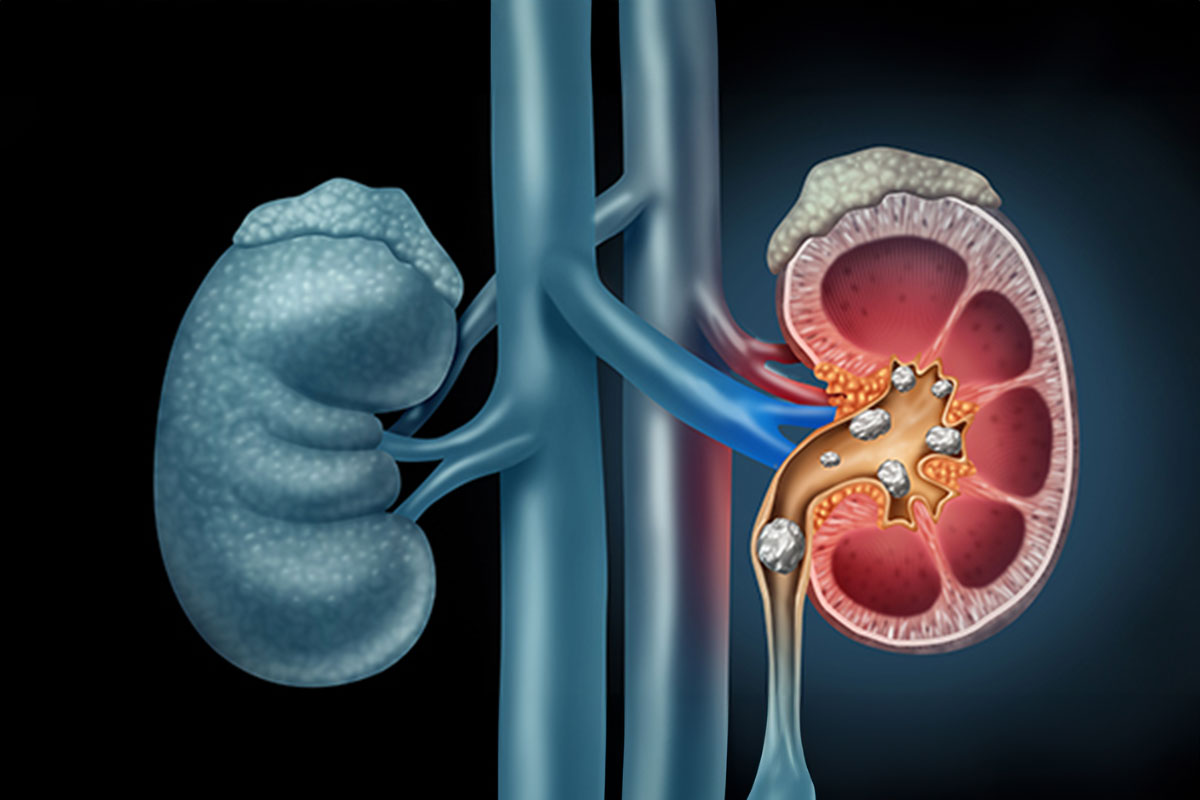 Kidney Stone Disease Treatment in Noida