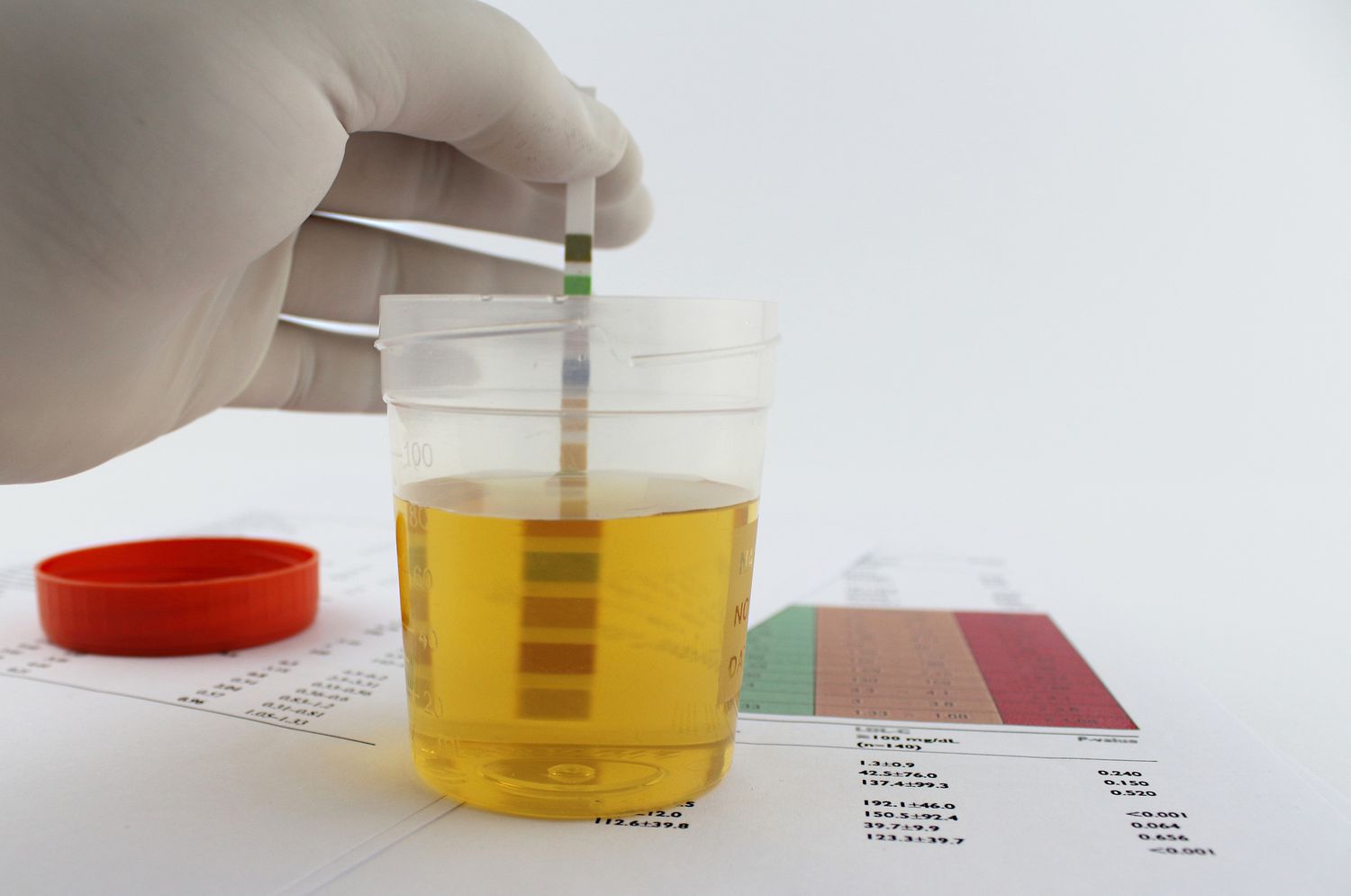 Protein in Urine Proteinuria Treatment in Noida