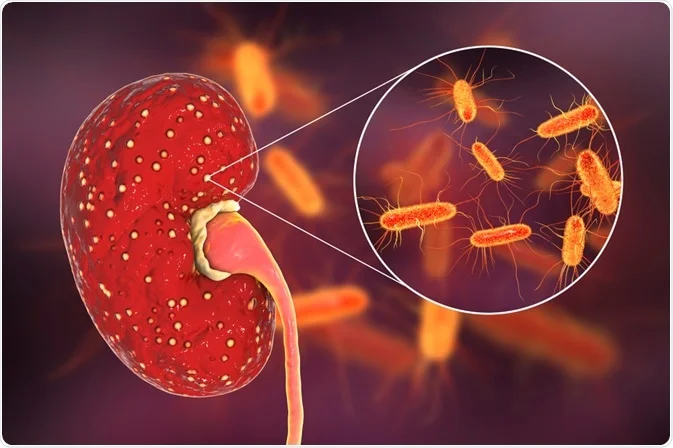 Pyelonephritis / Kidney infection